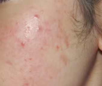 여드름 피부 트러블